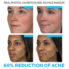 Load image into Gallery viewer, La Roche Posay Effaclar Duo Whitening Acne Removal Cream Acne Spots Oil Control Acne Moisturizing Cream Face Skin Care