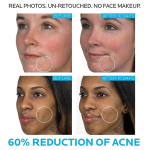 La Roche Posay Effaclar Duo Whitening Acne Removal Cream Acne Spots Oil Control Acne Moisturizing Cream Face Skin Care