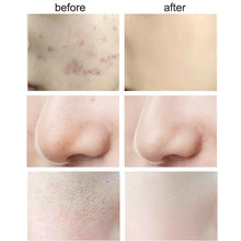 Load image into Gallery viewer, Drop Ship Face Skin Care AHA 30% + BHA 2% To Peel That Dead Top Layer Anti Makeup Serum Oil Balance Base 30ml